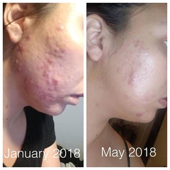 Super Acne Fighter / Trattamento Acne Biologico / Acne