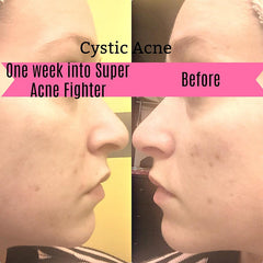 Super Acne Fighter / Trattamento Acne Biologico / Acne